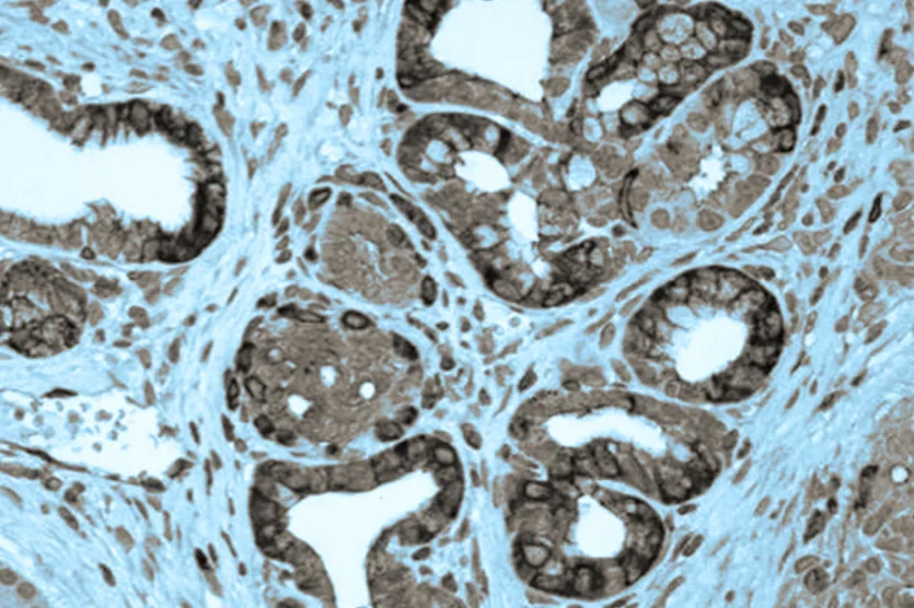 Cancer under microscope